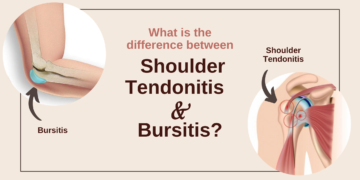 Shoulder Tendonitis and Bursitis