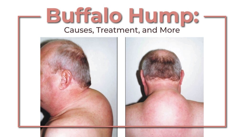 buffalo-hump-causes-treatment-and-more