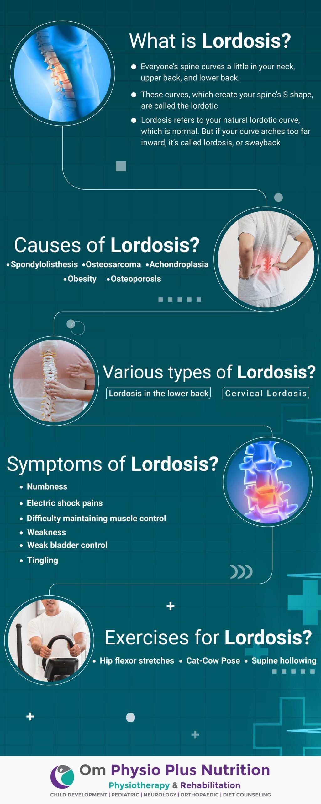 Lordosis Infographics