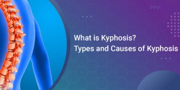 What is Kyphosis? Types and Causes of Kyphosis