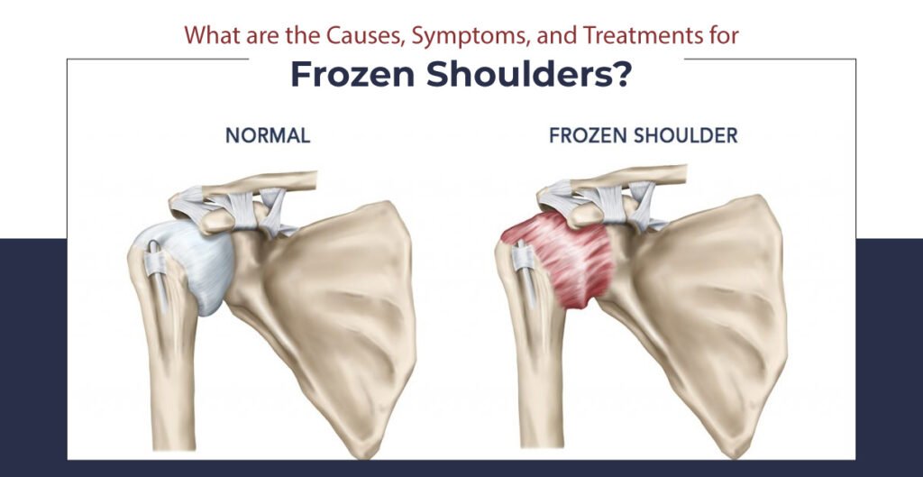 Causes, Symptoms, and Treatments for Frozen Shoulders